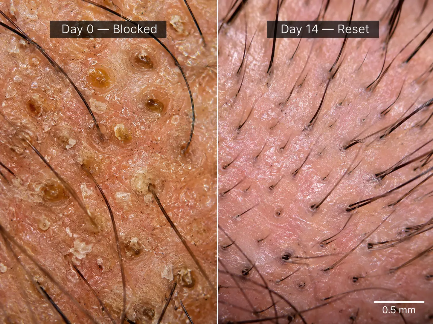 Comparison visual showing a congested scalp and a cleaner reset scalp
